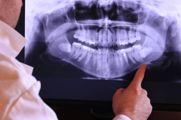 Best Emergency Wisdom Teeth Removal in Kendale Lakes, FL